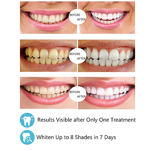 IDOLUSTER Teeth Whitening Kit-LED Light,Professional Tooth Whitener with 16X ...