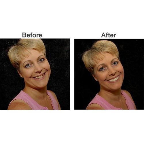 Imako Cosmetic Upper Teeth 1 Pack (Small, Natural)