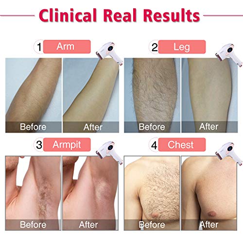 Permanent Hair Removal for Women & Men, IMENE 500,000 Flashes IPL Permanent H...