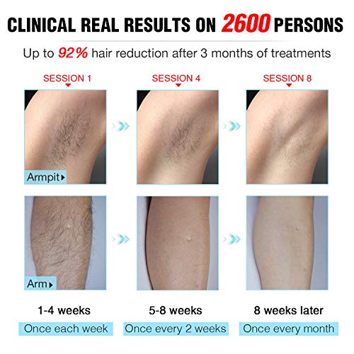 Permanent Hair Removal, IMENE Painless IPL Hair Removal - Ideal for Women & M...