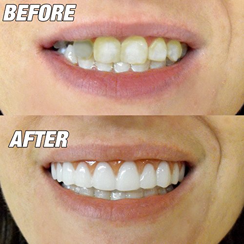 Instant Smile Comfort Fit Flex - Bright White Shade - Cosmetic Teeth, Comfort...