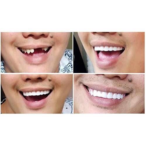 Instant Smile Comfort Fit Flex - Bright White Shade - Cosmetic Teeth, Comfort...