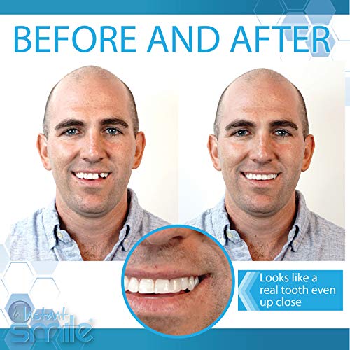 Instant Smile Complete Your Smile Temporary Tooth Replacement Kit - Replace a...
