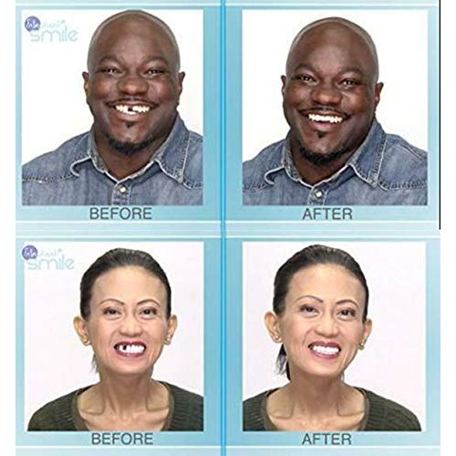 Instant Smile Multi-Shade Patented Temporary Tooth Repair Kit.