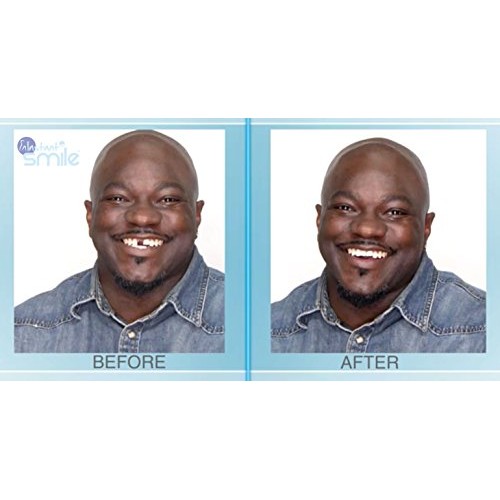 Instant Smile MULTISHADE Patented Temporary Tooth Repair Kit. A Realistic Loo...