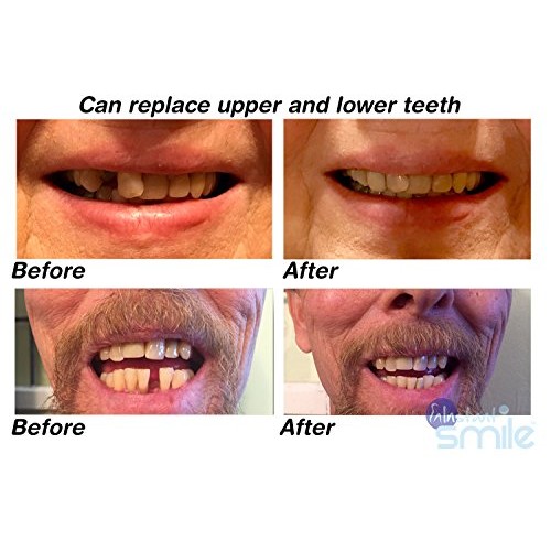 Instant Smile MULTISHADE Patented Temporary Tooth Repair Kit. A Realistic Loo...