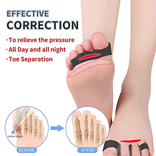 Toe Spacers,Toe Separators for Overlapping Toes,Correct Toes,Hammer Toe Corre...
