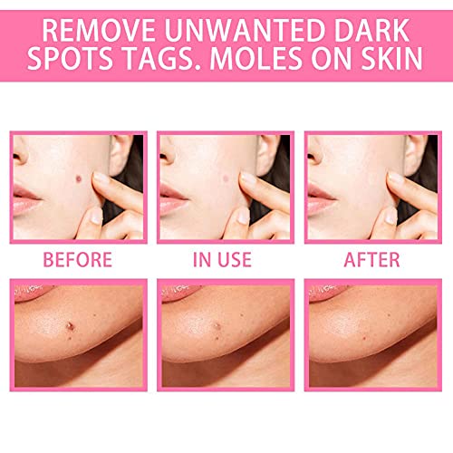 Jemets Skin Tag Remover Liquid Genital Wart Treatment Papillomas Removal Of W...