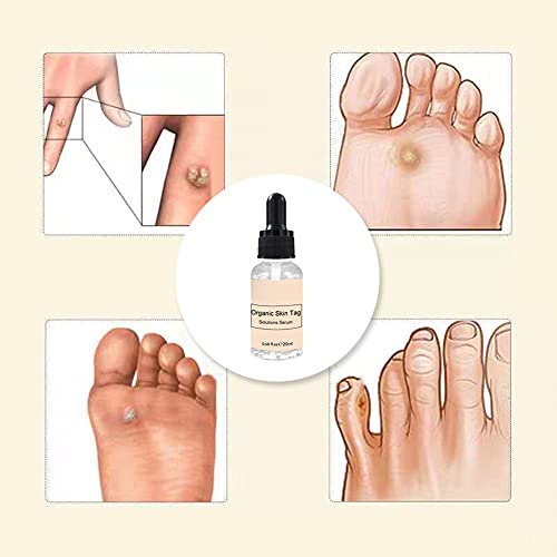Jemets Skin Tag Remover Liquid Genital Wart Treatment Papillomas Removal Of W...