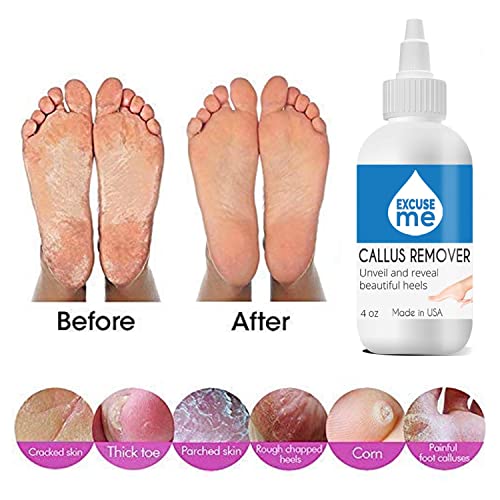 Excuse Me Feet Callus Remover, Liquid Gel for Callus and Corn Remove dead and...
