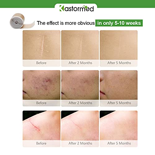 Silicone Tape for Scars, Soft Medical Tape Easy Removal for Keloid Bump Scars...