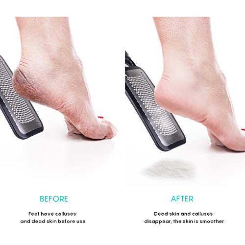 Feet Scrubber Dead Skin 5 Pack - KENED Foot File Callus Remover for Feet, Pro...