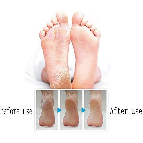 Foot Care Pedicure Callus Shaver Hard Skin Remover,Foot Callus Remover,Callus...