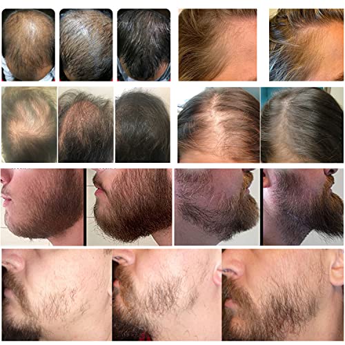 Koi Beauty Derma Roller 540 Titanium (Non-Slip Advanced Matte Black) Hair Bea...