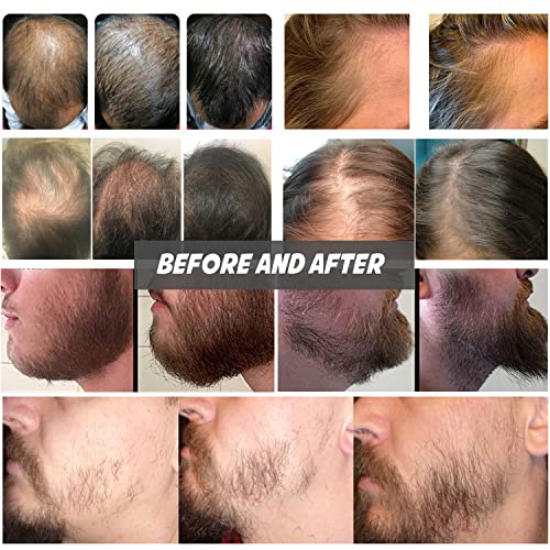 Koi Beauty Professional Derma Stamp Adjustable Titanium Microneedling Pen Mic...