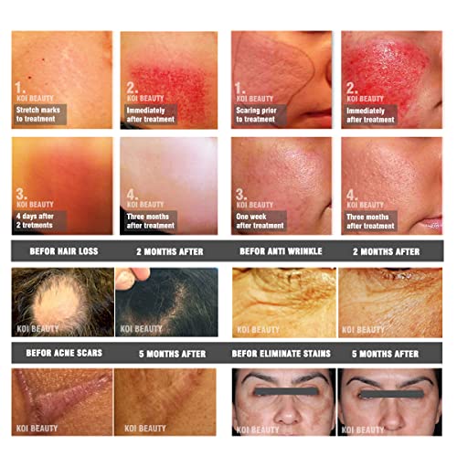 Koi Beauty Professional Microneedling Derma Roller for Face Body Beard Hair G...