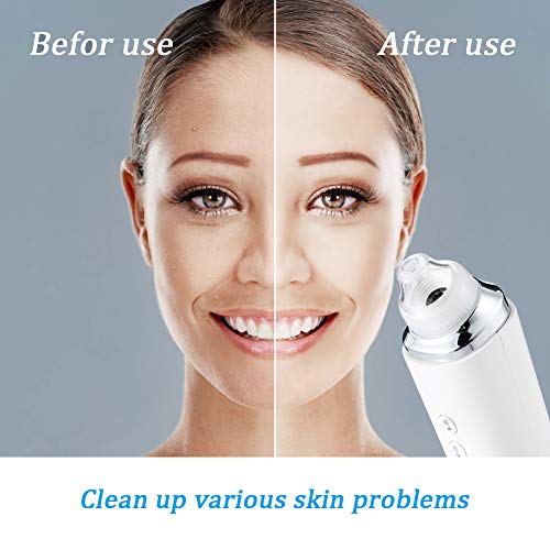 Visual Blackhead Remover Pore Vacuum - Koolertron 5.0 Megapixels HD Camera Wi...