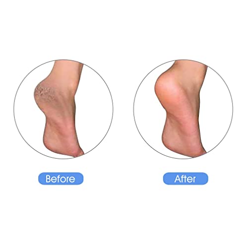 KuuCare Pumice Stone for Feet, Natural Earth Lava Pumice Stone - Foot File Ca...