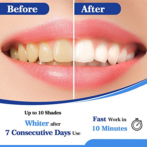 Teeth Whitening Kit with LED Light by Lagunamoon, 35% Urea Peroxide Teeth Whi...