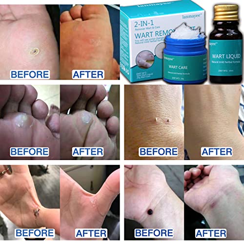 Lanmayee Wart Remover Wart Removal Kit,Best Wart Skin Tag Remover,Corn Remove...