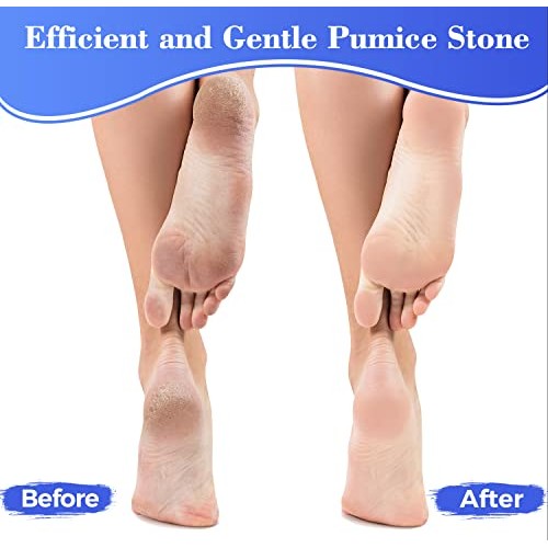 Pumice Stone for Feet Foot Scrubber - Larbois 4Pack Pumice Stone for Feet Cal...