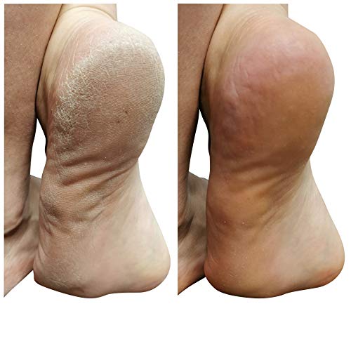 Lee Beauty Professional Callus Remover Extra Strength Gel for Feet, At Home P...