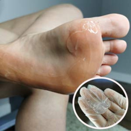 Lee Beauty Professional Callus Remover Extra Strength Gel for Feet, At Home P...