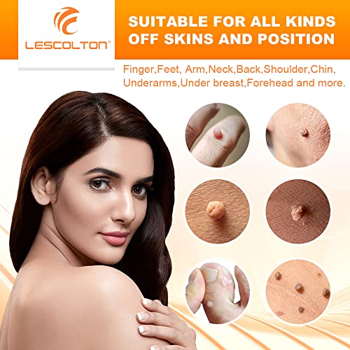 Lescolton Skin Tag Removal Kit 2-7mm Skin Tag Remover Device 40 Bands Skin Ta...
