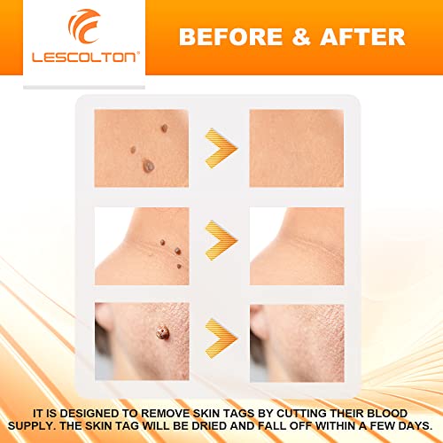 Lescolton Skin Tag Removal Kit 2-7mm Skin Tag Remover Device 40 Bands Skin Ta...