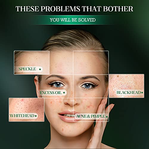 Blackhead Remover Mask Blackhead Peel Facial Mask Charcoal Facial Mask,With H...