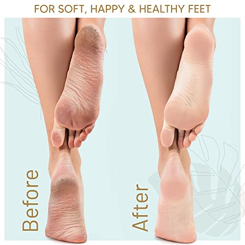 Foot Callus Remover Gel 6oz By Love, Lori - Callus Remover For Feet & Dead Sk...
