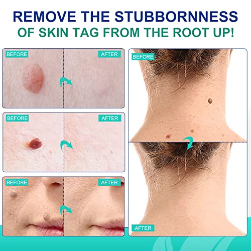 Skin Tag Remover, Wart & Mole Remover, Natural Plant Extracts, Easy to Apply,...