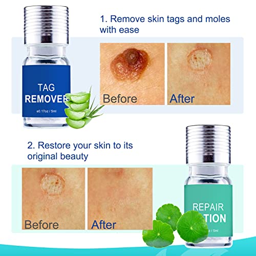 Skin Tag Remover, Wart & Mole Remover, Natural Plant Extracts, Easy to Apply,...