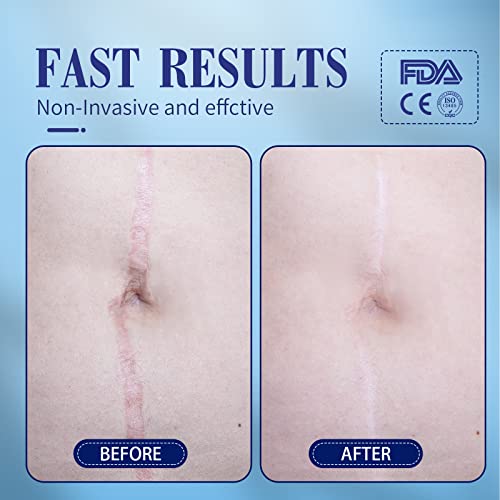 Lysam Silicone Scar Sheets, Professional Silicone Scar Tape, (1.57 x 60 inche...