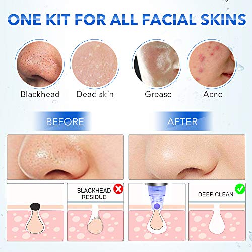Blackhead Remover Vacuum, Electric Pore Vacuum Facial Pore Cleaner Acne Comed...