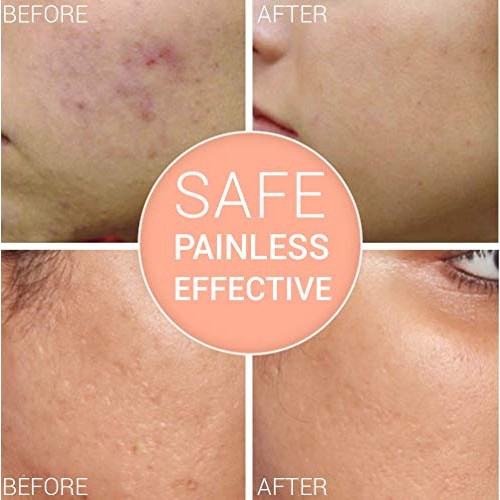 Micro Derma Roller for Face - Medical-Grade Stainless Steel Microneedle Rolle...