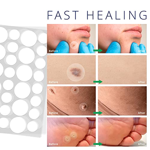 Skin Tag Remover Patches, 144 PCS New and Improved Formula Skin Tag Removal P...