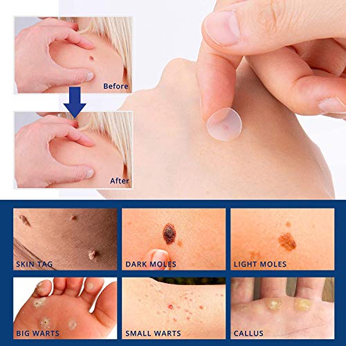 Skin Tag Remover Patches, 144 PCS New and Improved Formula Skin Tag Removal P...