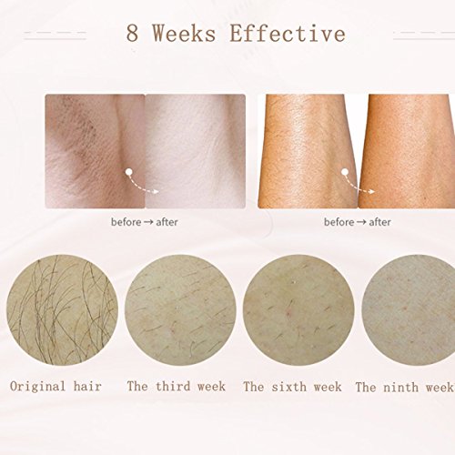 MLAY T3 Face and Body Hair Removal System - Painless Permanent Hair Removal D...