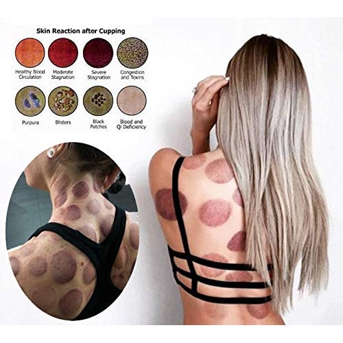 Cupping Set Professional Chinese Acupoint Cupping Therapy Sets, Suction Hijam...