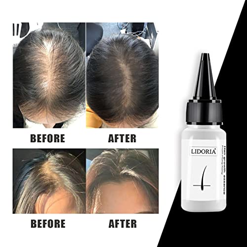 Hair Growth Serum, Serum for Hair Growth, Hair Regrowth Treatment for Hair Lo...