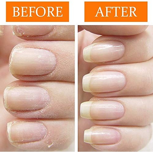 Nail Tek Nail Recovery Kit, Cuticle Oil, Strengthener, Ridge Filler - Restore...