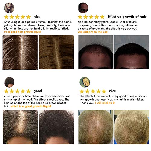 Derma Roller for Hair Growth, Biotin Hair Growth Oil Serum, Hair Scalp Massag...