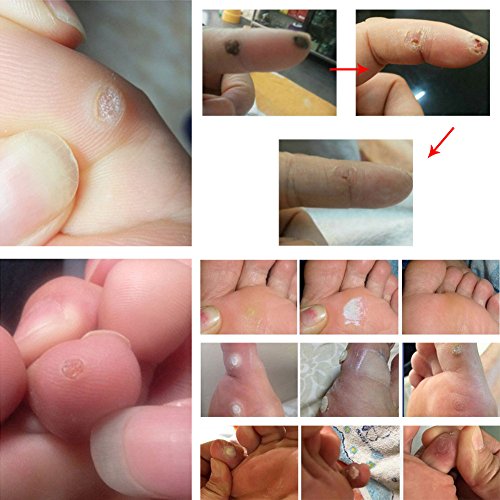 Corn Remover, Corn Removal, Corn Remover Liquid, Foot Corn Removal, Corn Call...