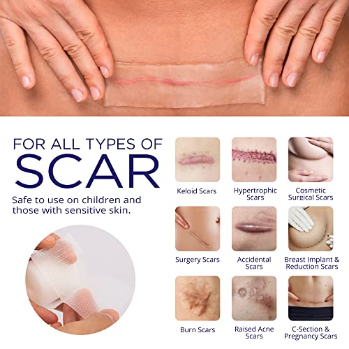 Advanced Silicone Scar Sheets Medical Grade Silicone Gel Tape Roll for Scar R...