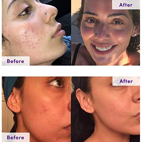 NxN Acne Treatment Kit 4-Step Clear Skin System with Salicylic Acid, Probioti...