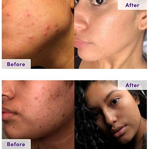 NxN Acne Treatment Kit 4-Step Clear Skin System with Salicylic Acid, Probioti...