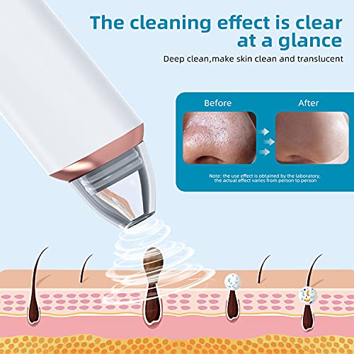 Oiiwak Blackhead Remover Pore Vacuum with Camera Visual Facial Blackhead Pimp...