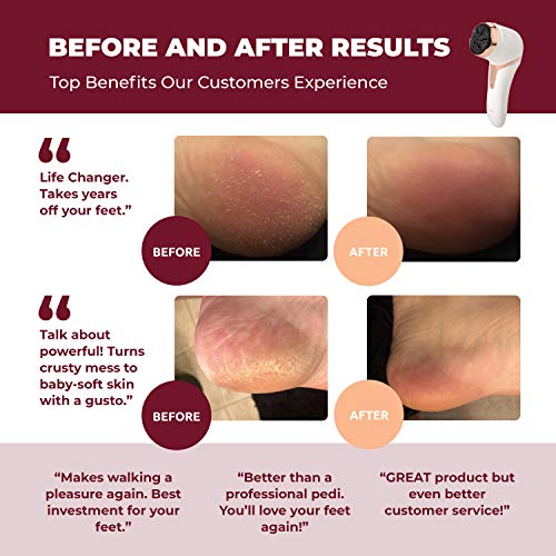 Own Harmony Electric Callus Remover with Vacuum - Foot Care for Women - Profe...