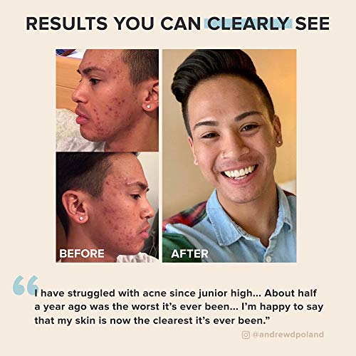Paula's Choice CLEAR Extra Strength Acne Kit, 2% Salicylic Acid & 5% Benzoyl ...